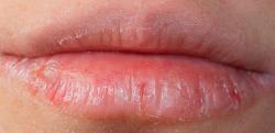 Labios secos y agrietados: señal de que comemos mal